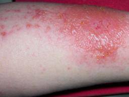 Allergic Contact Dermatitis Treatment1