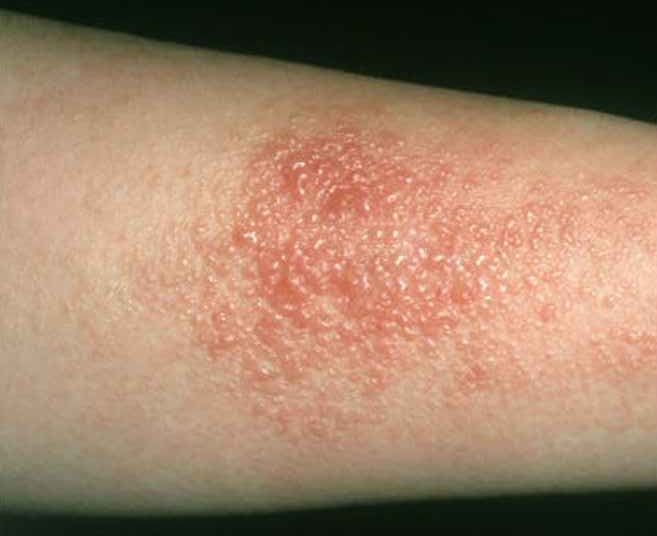 Allergic Contact Dermatitis Treatment2