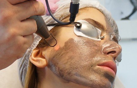 Why Us 5 Carbon laser peel2 1