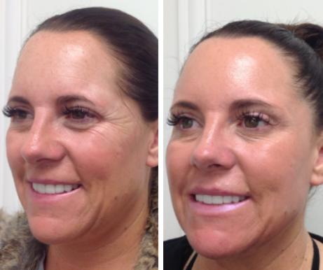 FRACTIONAL CO2 TREATMENTS23 1