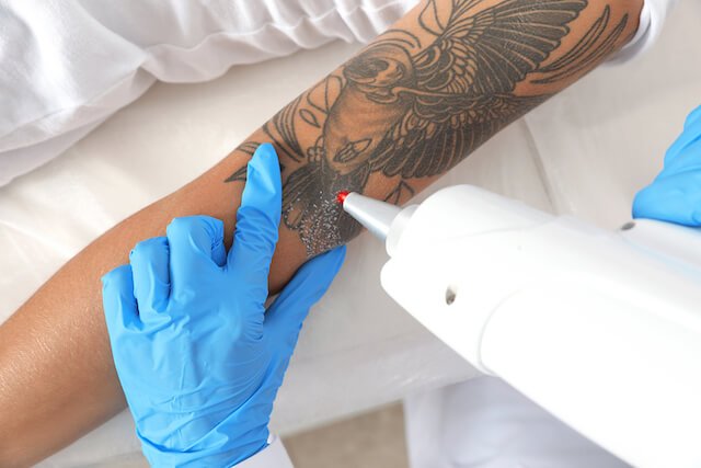 LASER TATTOO REMOVAL TREATMENT4