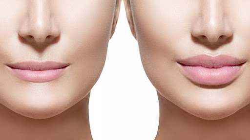 Lip Reduction Treatment1