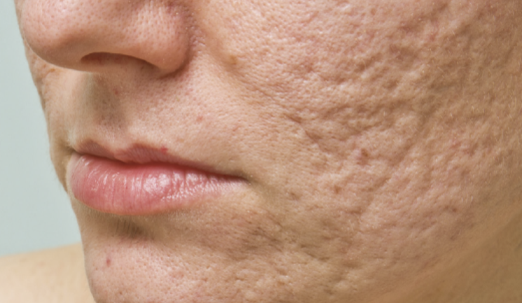 Microneedling for acne scars1