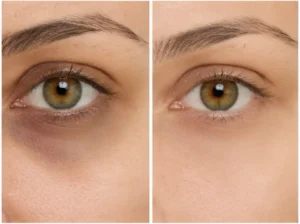 Dark Circles Treatment Islamabad
