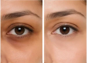 Dark Circles Treatment in Islamabad