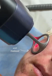 Acne Scar Laser Stacking Aesthetic Physician Islamabad