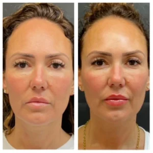 non surgical face lift in islamabad by dr shumaila khan in Dermalase Clinic F10 Islamabad