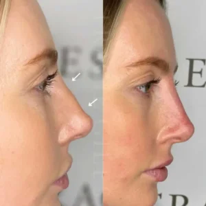 Before and After results of non surgical nose job in islamabad by Dr Shumaila Khan in Islamabad.