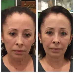 Thread Lift Treatment in Islamabad 12 Before and after results of Thread lift treatment in Islamabad by Dr Shumaila Khan