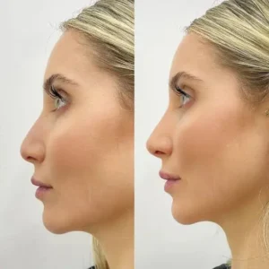 Before and After results of non surgical nose job in islamabad by Dr Shumaila Khan in Islamabad.