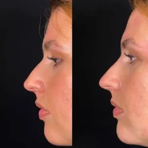 Before and After results of non surgical nose job in islamabad by Dr Shumaila Khan in Islamabad.