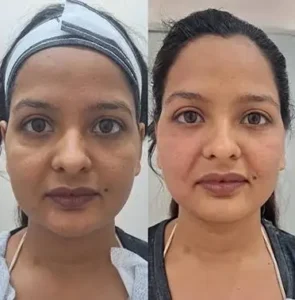 Thread Lift Treatment in Islamabad 14 Before and after results of Thread lift treatment in Islamabad by Dr Shumaila Khan