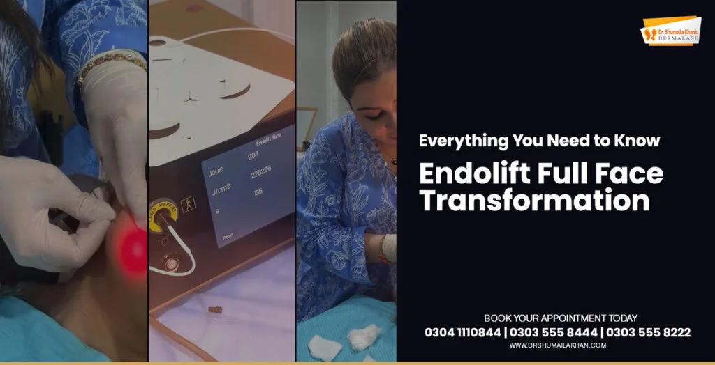 Endolift-Full-Face-Transformation-Cover-Post-by-Dermatologist-Dr.-Shumaila-Khan-in-Islamabad-1024x524