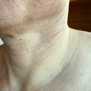 Loose, Crepey or Lax Neck Skin